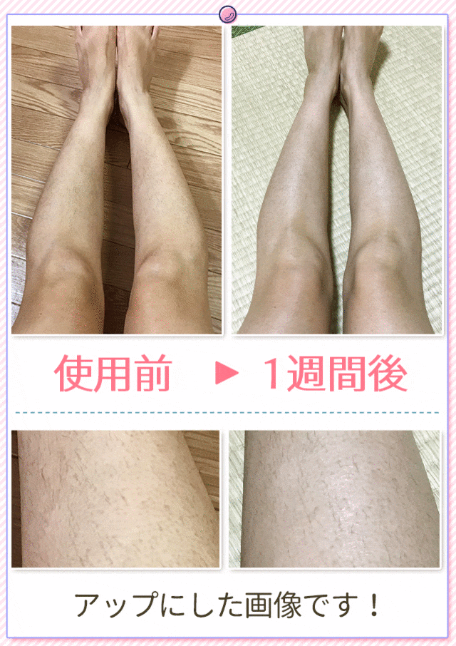 脚のムダ毛ケア
